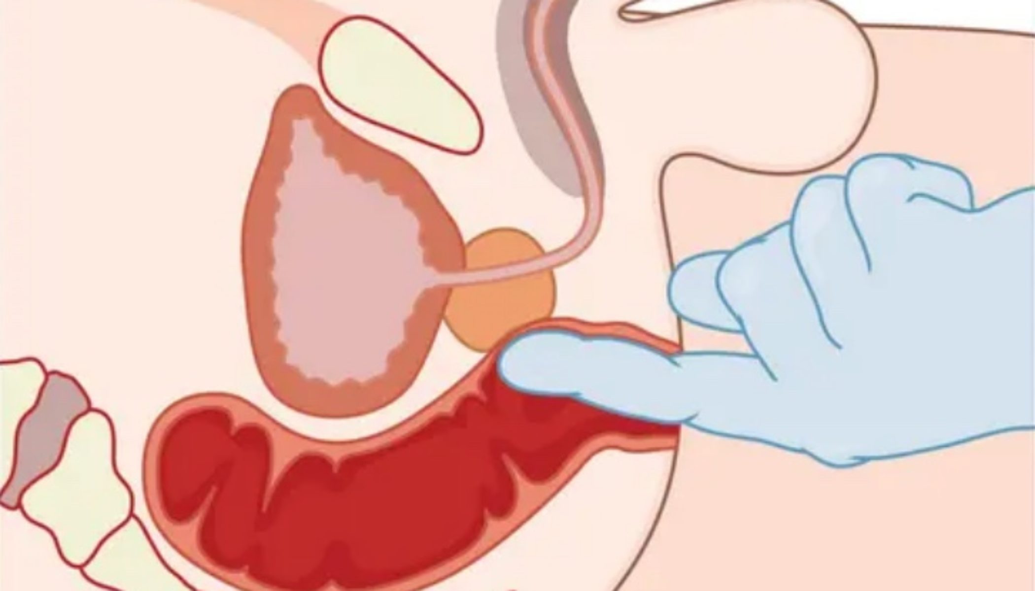 cancer de prostata sintomas avanzado microclistere cu ozon pentru prostatita cronică