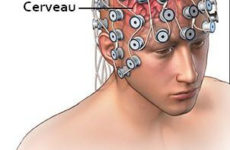 Épilepsie et troubles de la mémoire
